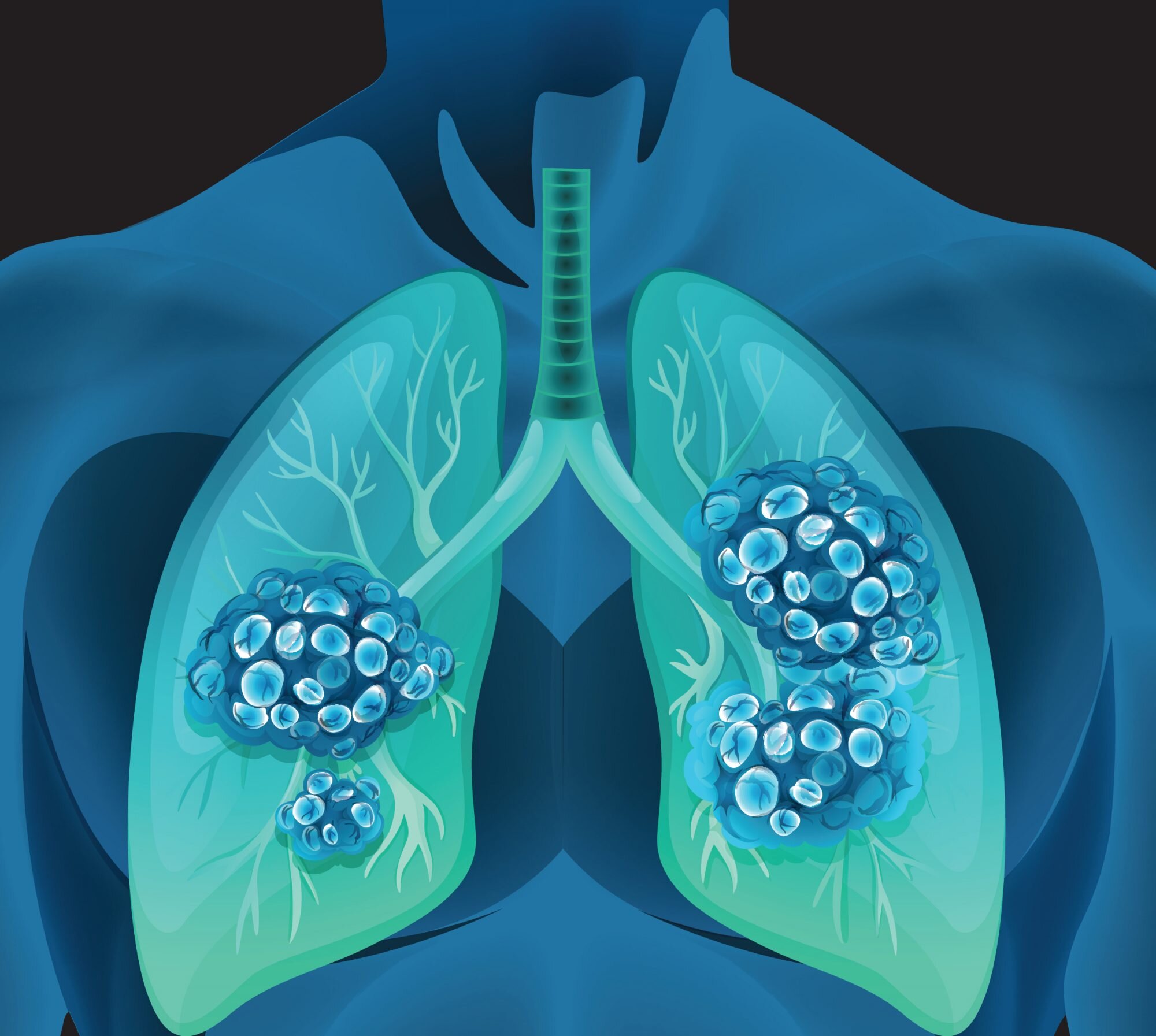 what-to-know-about-lung-cancer-diagnosis-treatment-allied-meetings